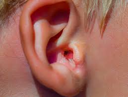 swimmers ear