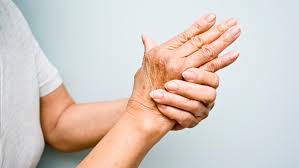 Arthritic Hand