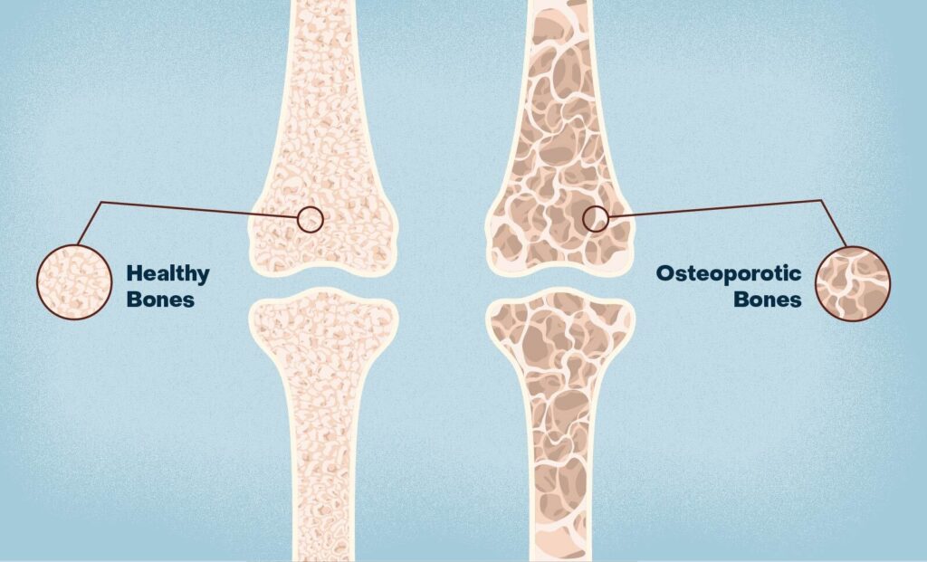 Osteoporosis in bones